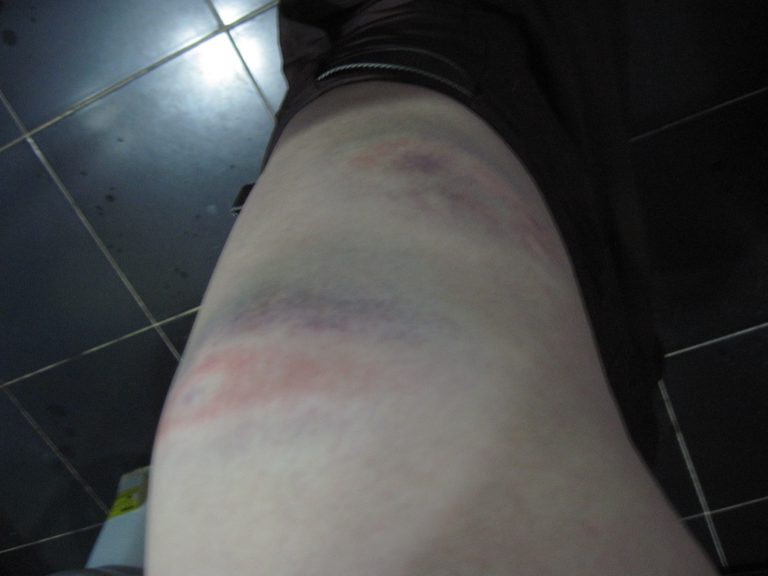 Leg bruises